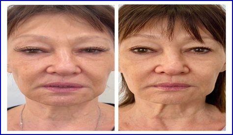 Has Marie Osmond Done Facelift And Plastic Surgery? Before And After Pics, Age And Height